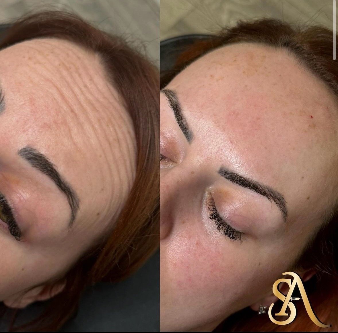 Anti Wrinkle Injections